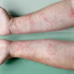 Is Krill Oil Better Than Fish Oil for Eczema