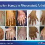 Is Krill Oil Better Than Fish Oil for Rheumatoid Arthritis