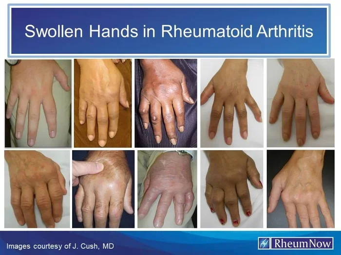 Is Krill Oil Better Than Fish Oil for Rheumatoid Arthritis